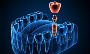A 3D image for dental implant.